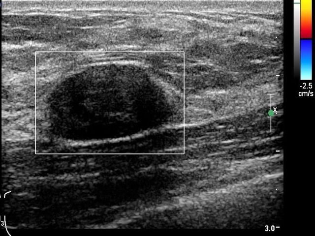 fibroadenoma